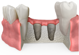 Bone-Grafting-After-Extraction