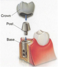 Dental Implants Dentist Miami